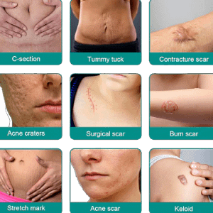 Fade scars fast with ScarRemove™ Advanced Spray—hydrates, smooths, and restores skin from surgery, burns, or stretch marks naturally.