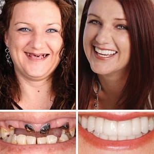 ROSOPLTM – Immediate Dentures