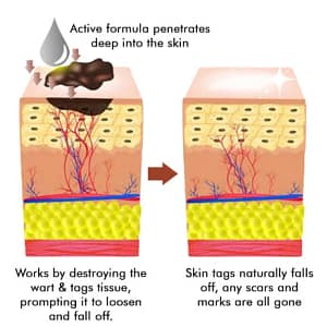 LOVILDS™ Warts & Tags Remover