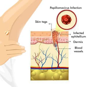 LOVILDS™ Warts & Tags Remover