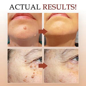 LOVILDS™ Warts & Tags Remover