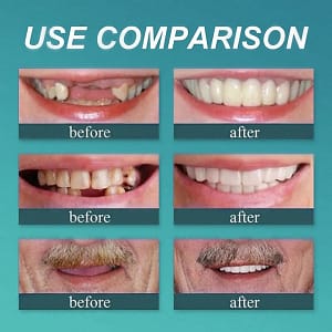 ROSOPLTM – Immediate Dentures