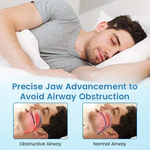 ALISANDA PerfectSleep Solution – Snore-Reducing & Teeth-Grinding Guard