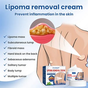 Cvreoz® Lipoma Removal Cream