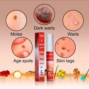 LOVILDS™ Warts & Tags Remover