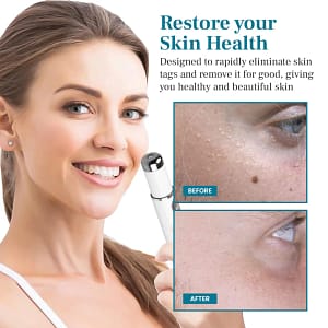 DAFEILA® LumeSkin Mole and Wart Removal Laser Pen