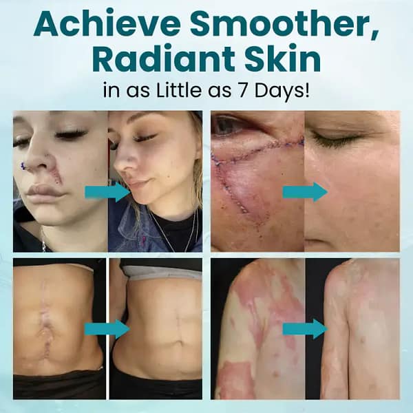 Zvoevo® Advanced Scar Gel for Surgical Scars