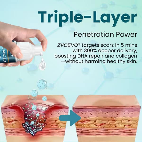 Zvoevo® Advanced Scar Gel for Surgical Scars